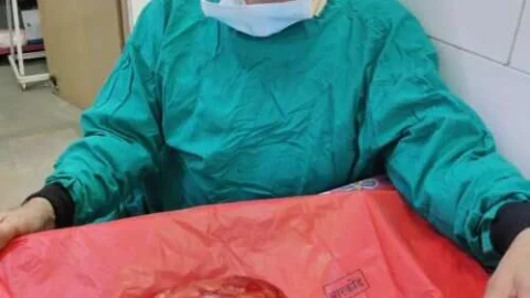 महिला की बच्चादानी सेे 3 किलो 800 ग्राम की गांठ निकाली