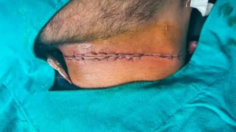 बाइक चालक बना चाइनीज मांझे का शिकार, 16 टांके आए