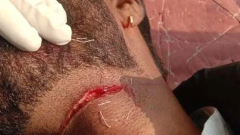 चाइनीज मांझे का शिकार हुआ मोटरसाइकिल सवार