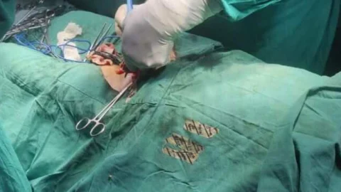 जिला चिकित्सालय में हुई पाइलोनिडल साइनस की सफल प्लास्टिक सर्जरी