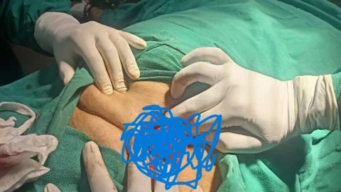 जिला चिकित्सालय में हुई सफल दुर्लभ हर्निया सर्जरी